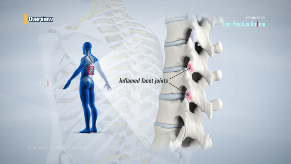 Facet Joint Injection​